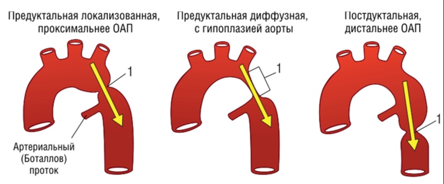 Варианты коарктации аорты