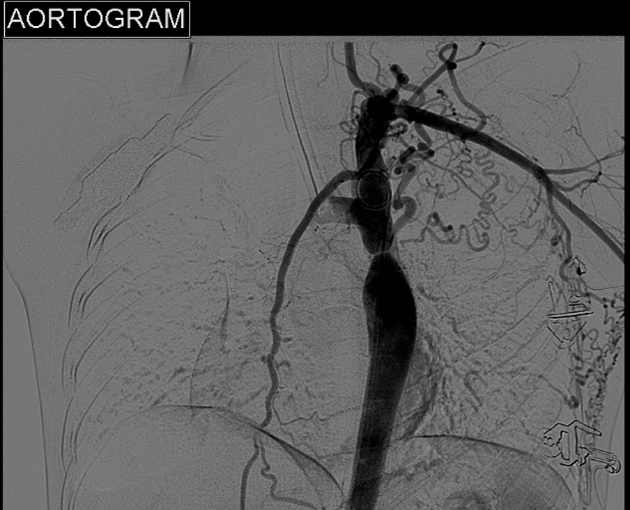 Выраженная коарктация в постдуктальном сегменте нисходящей грудной аорты